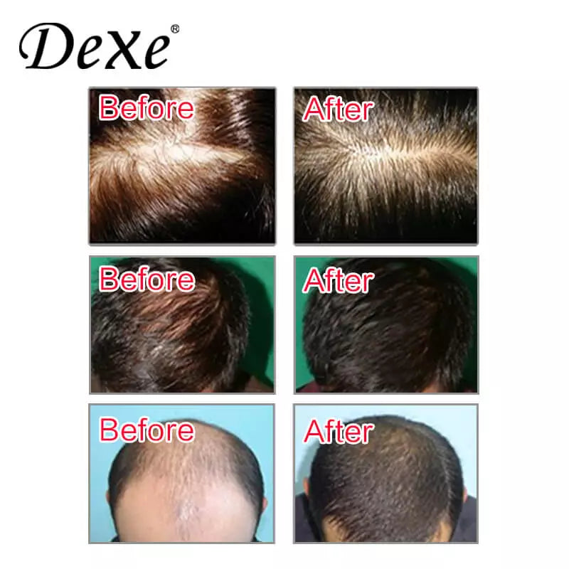 Dexe Anti-Hair Loss Shampoo